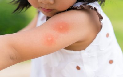 Organic DIY Mosquito Control Tips